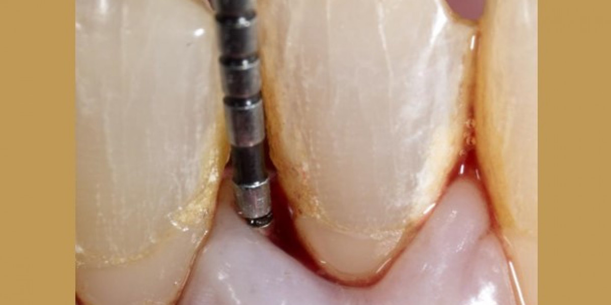 Dental implants Clinics in Kerala