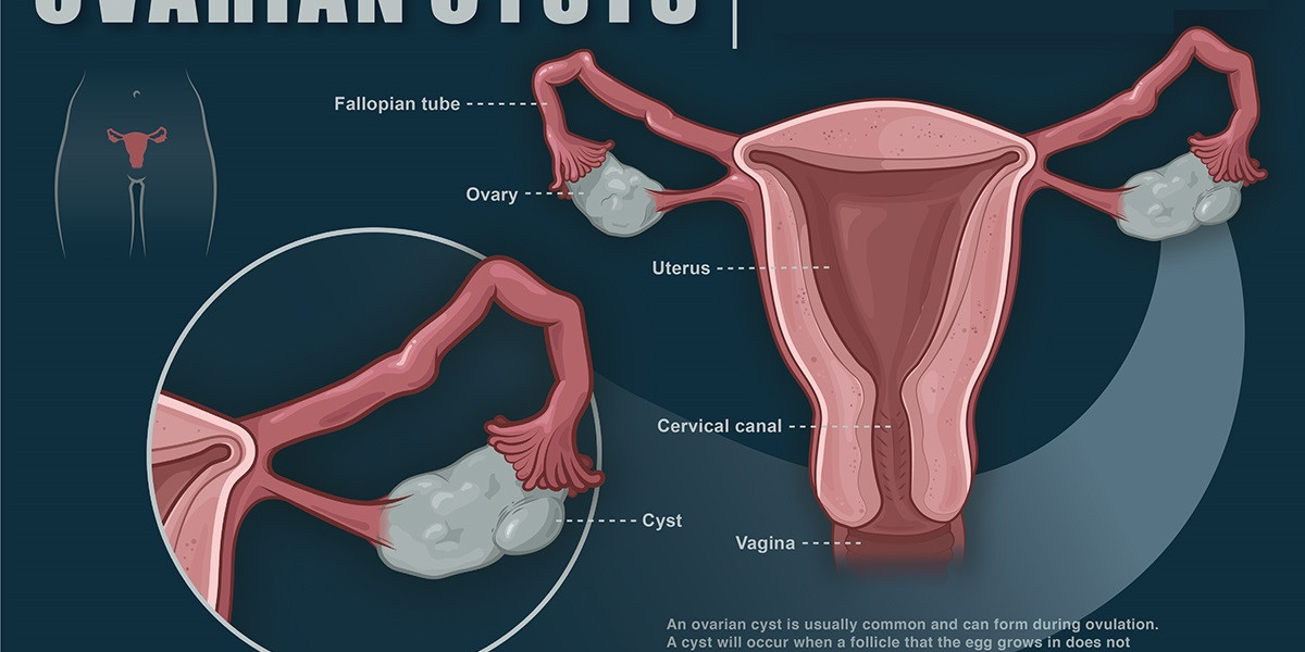 Ovarian Cysts Market to Worth USD 3.3 Billion Registering 23.5% CAGR by 2032