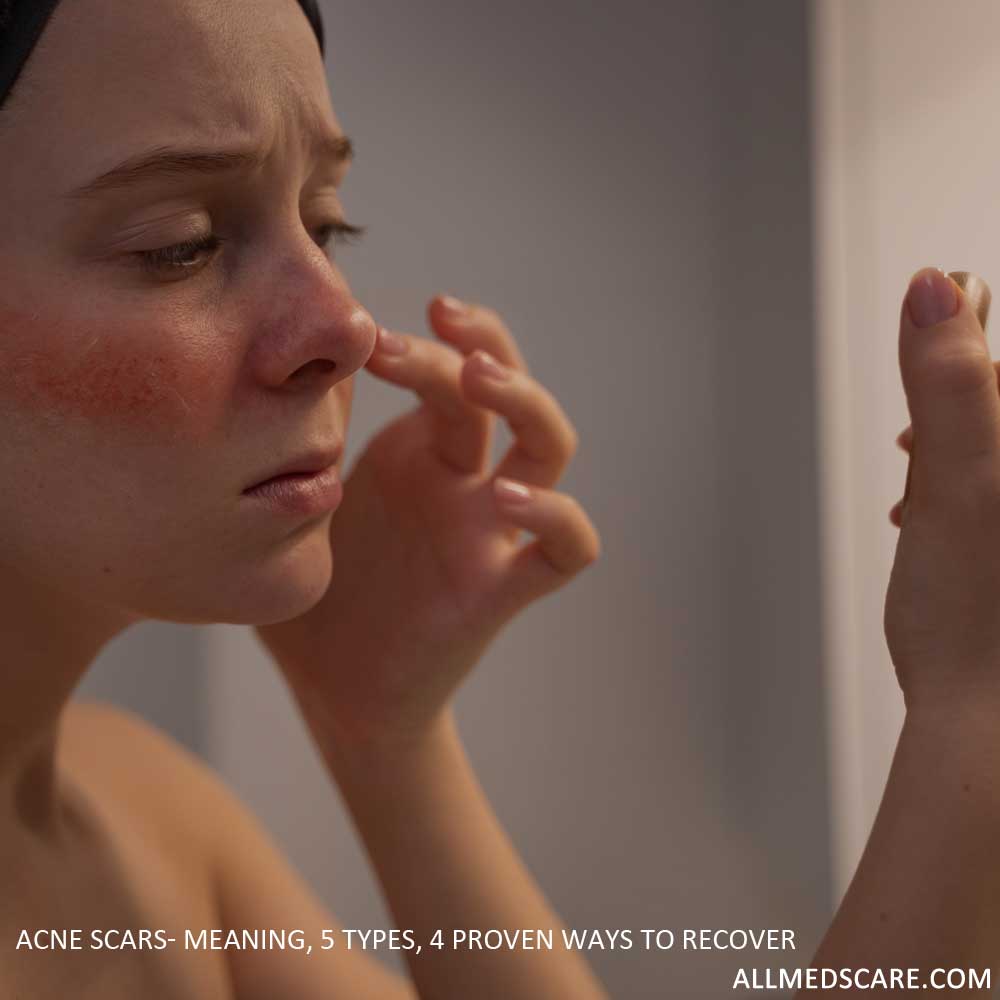 Acne Scars- Meaning, 5 Types, 4 Proven Ways to Recover - Allmedscare.com