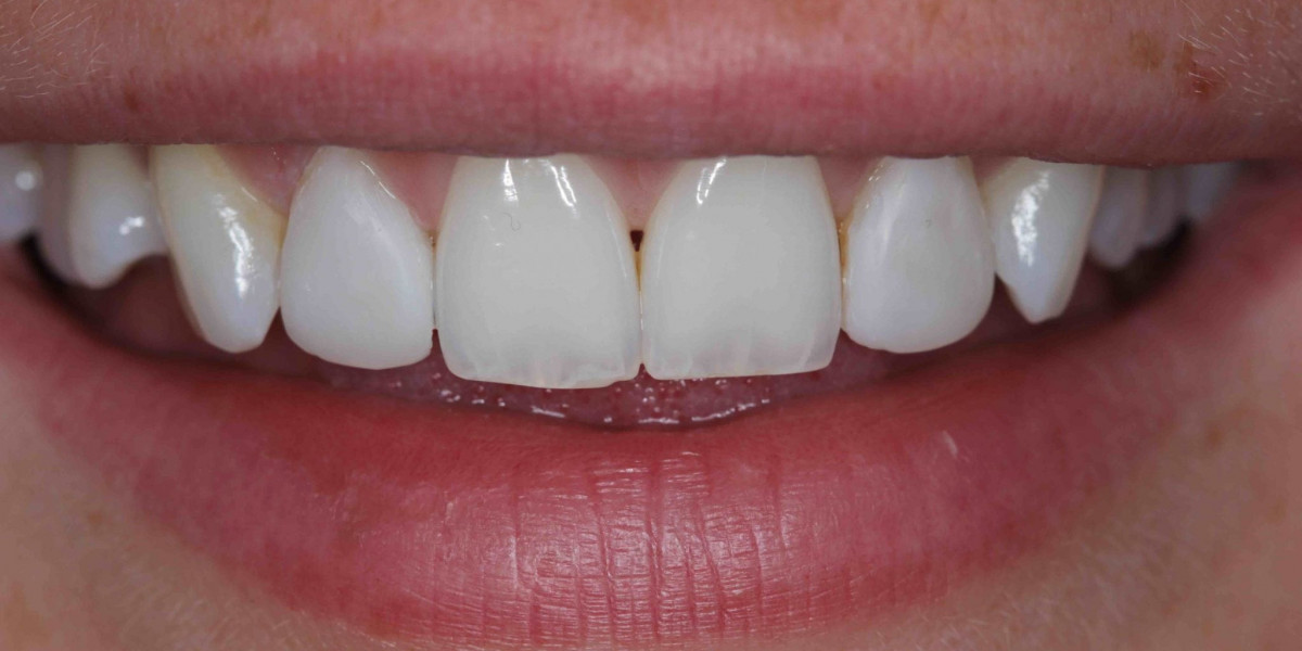 ¿Cómo funciona la implantación en el momento en que faltan varios dientes?