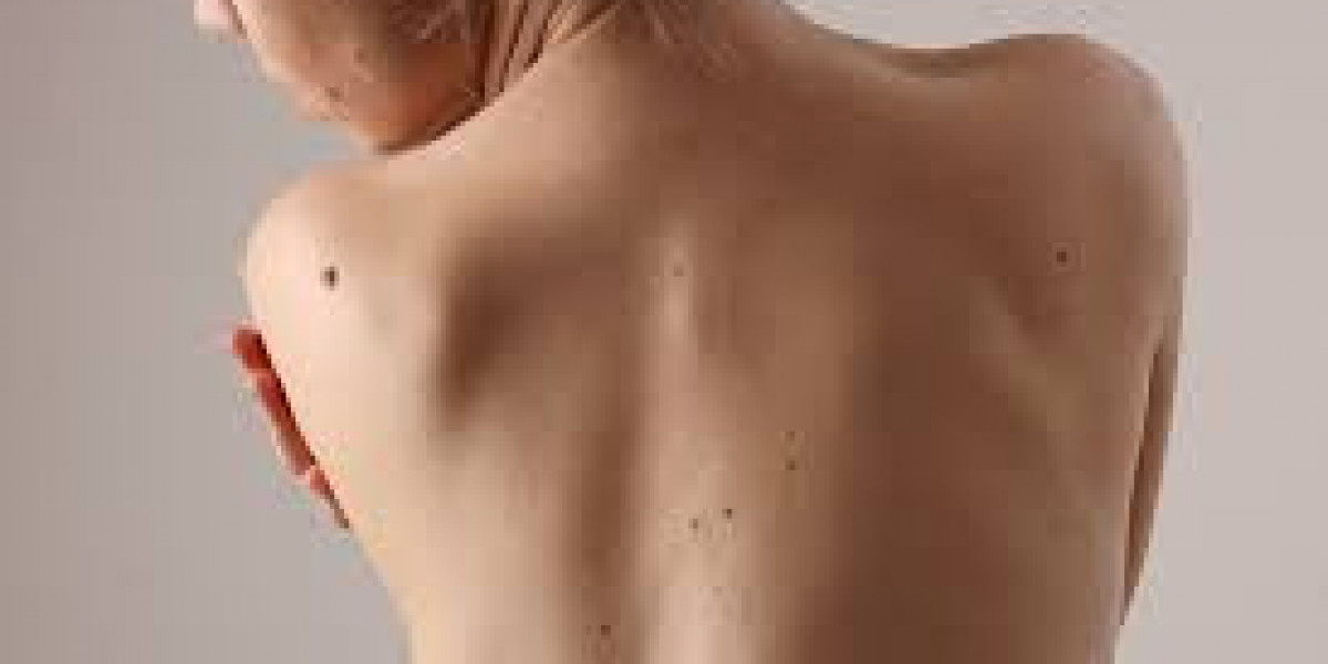 Mole Removal Sydney: Quick, Painless, and Barely-There Procedures