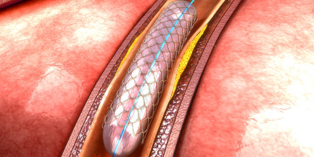 Best Peripheral Angioplasty in Jaipur: Expert Care at Eternal hospital