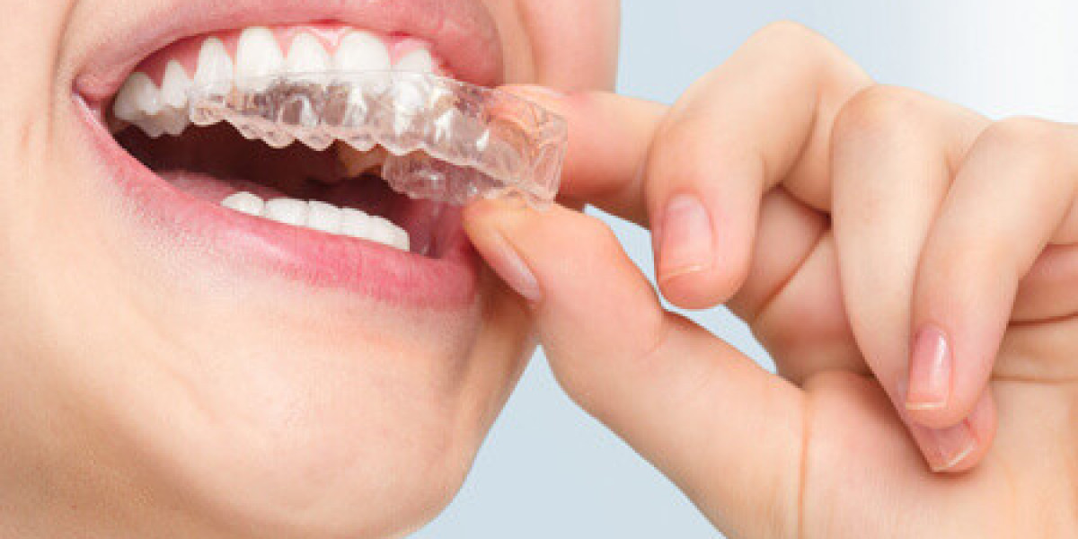 Invisible Braces: A Discreet Way to Achieve a Perfect Smile